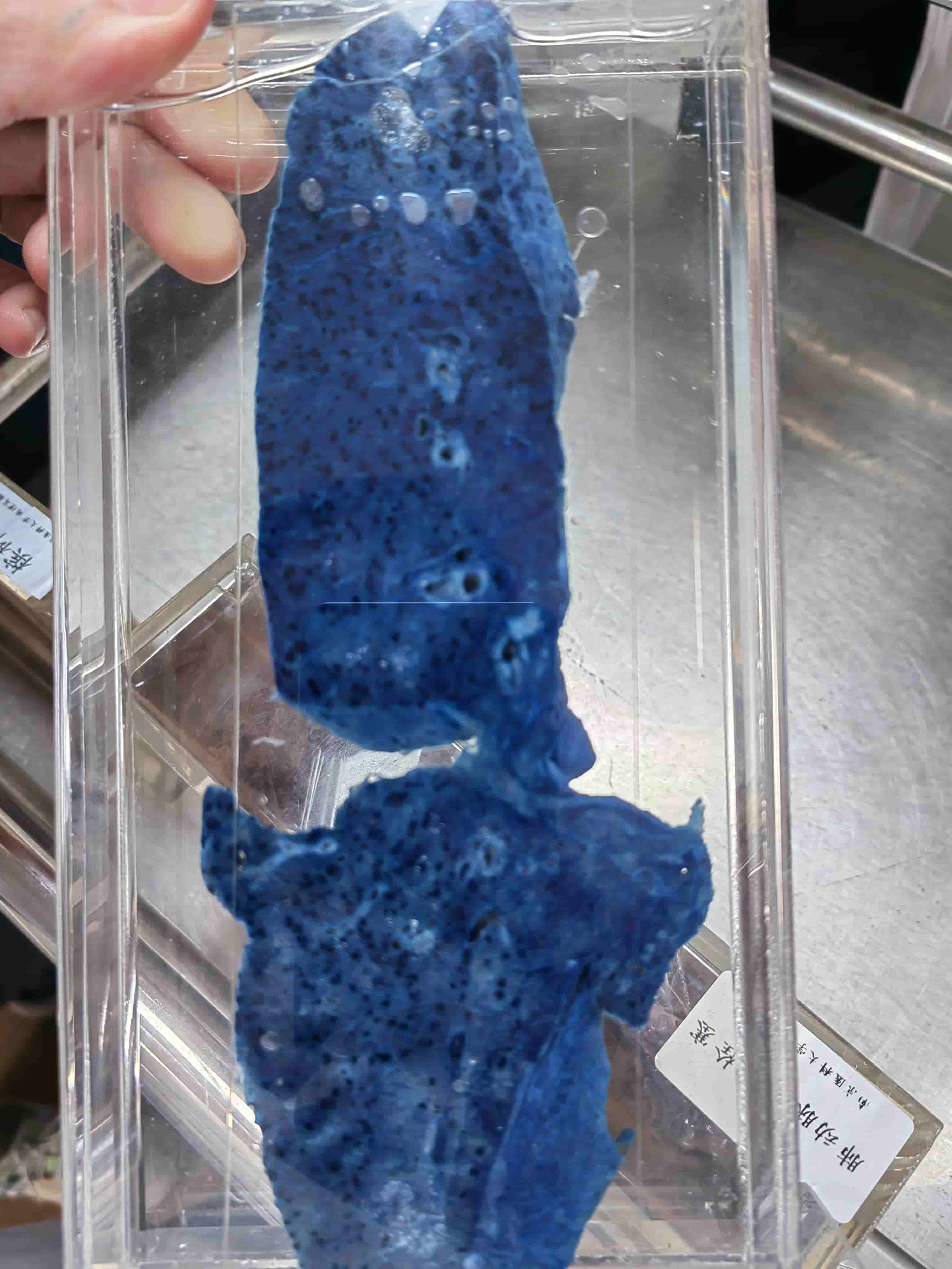 肺褐色硬化(普鲁士蓝染色).jpg